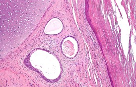 Teratoma_2_intermed_mag.jpg